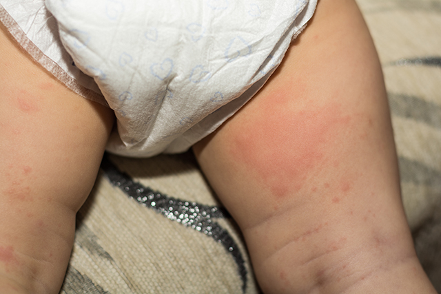 diaper rash remedy