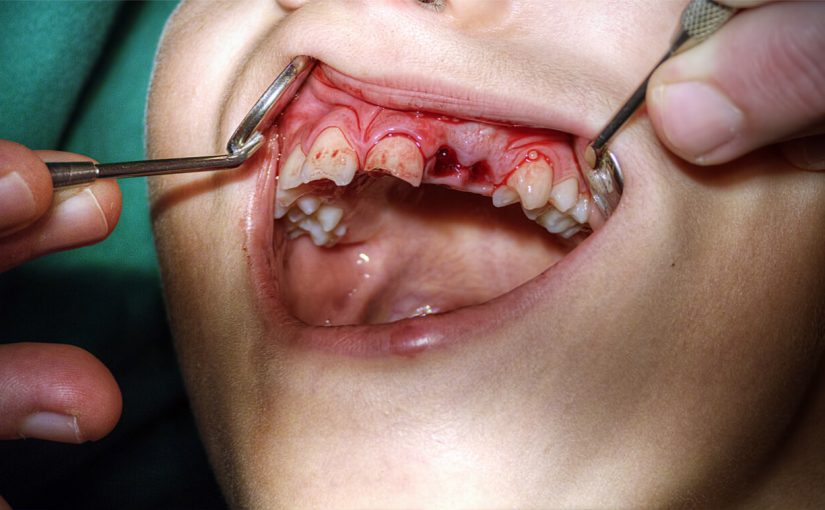 Tooth Avulsed Treatment