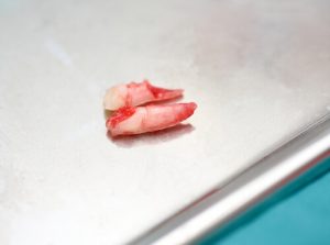 tooth avulsed