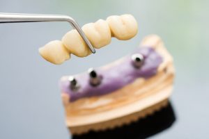 dental bridge pain