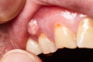 periodontal abscesses