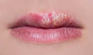 lip cancer tingling sensation